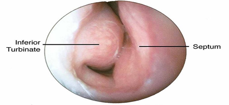 nasalallergy-Sri Sai Hospital