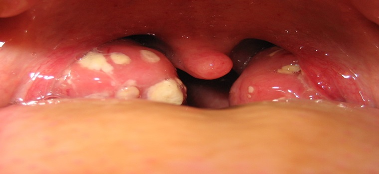 tonsil-Sri Sai Hospital